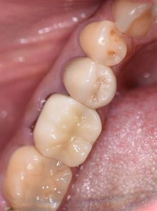 Crowns Case 21 - Beeville, TX - After