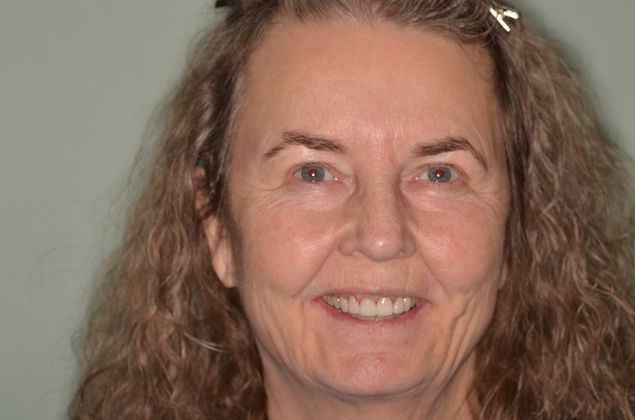 Porcelain Veneers Case 25 - Before