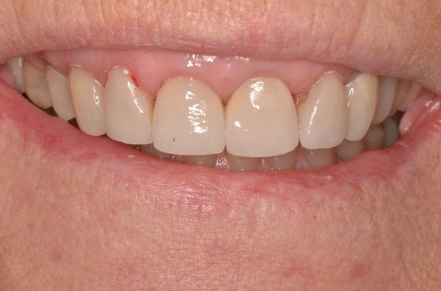 Porcelain Veneers: Case 25 - Before Porcelain veneers
