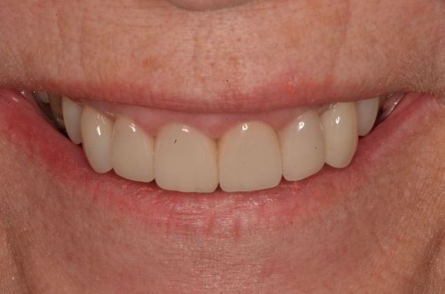Porcelain Veneers: Case 25 - After Porcelain veneers