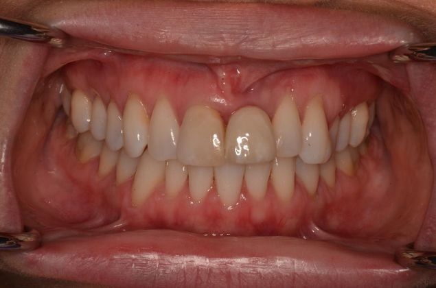 Porcelain Crowns Case 5 - Before