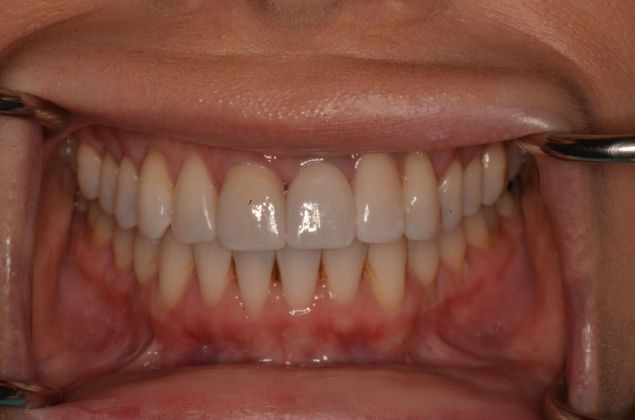Porcelain Crowns Case 5 - After