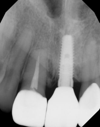 Porcelain Crowns: Case 5 - After