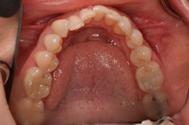 Invisalign: Case 16 - Before invisalign