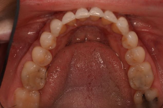 Invisalign: Case 16 - After Invisalign