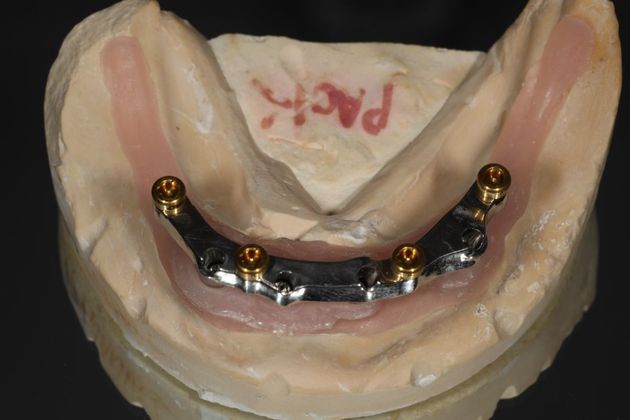 All-on-4 / All-on-X: Case 7 - Before