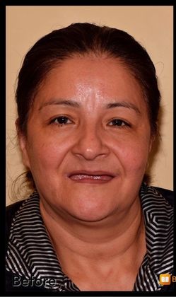 All-on-4 / All-on-X: Case 7 - Before