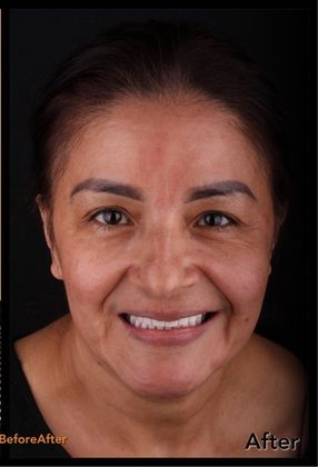 All-on-4 / All-on-X: Case 7 - After