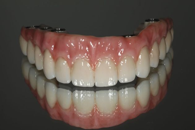 All-on-4 / All-on-X: Case 7 - After