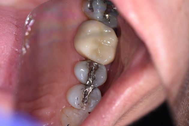 Crowns Case 22 - Inez, TX - After