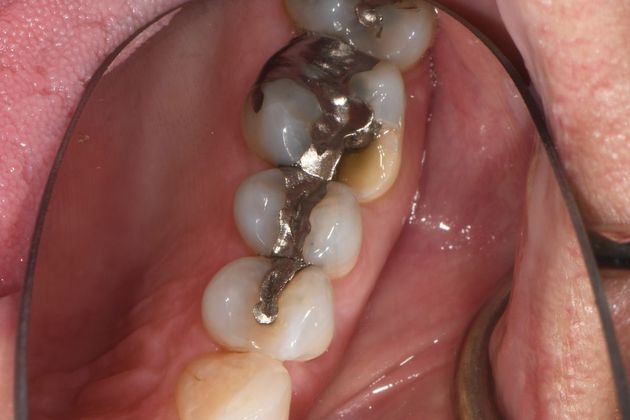 Crowns Case 22 - Inez, TX - Before