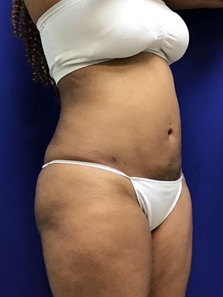 Body Buttock Enhancement: Case 6 (31275) - After