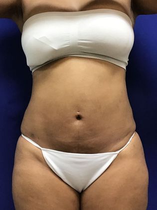 Body Buttock Enhancement: Case 6 (31275) - After