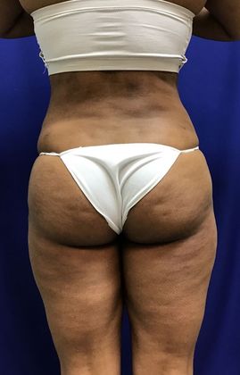 Body Buttock Enhancement: Case 6 (31275) - After. Excellent waist-butt ratio