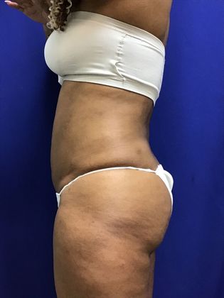 Body Buttock Enhancement Case 6 (31275) - After