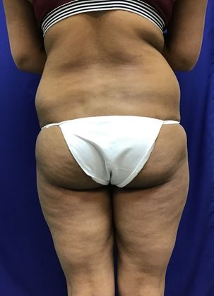 Body Buttock Enhancement: Case 6 (31275) - Before, prominent love handles