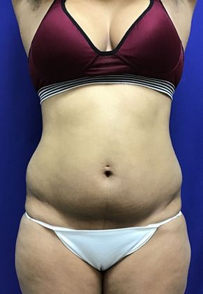 Body Buttock Enhancement: Case 6 (31275) - Before