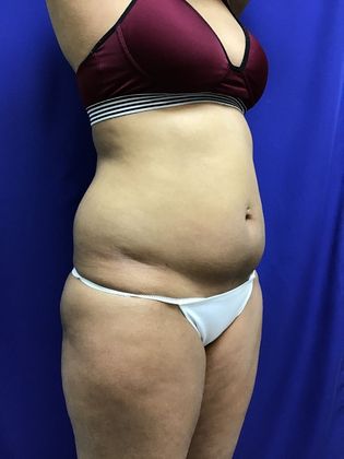 Body Buttock Enhancement: Case 6 (31275) - Before.  Tummy/flank bulges