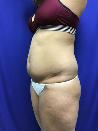 Body Buttock Enhancement Case 6 (31275) - Before