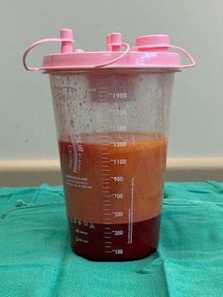 Body Buttock Enhancement: Case 6 (31275) - Typical fat used to graft