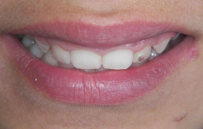 Orthodontics: Case 3 Gummy smile - Before