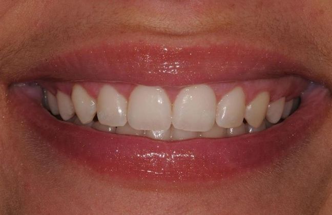 Orthodontics: Case 3 Gummy smile - After