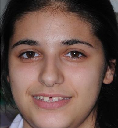 Orthodontics Closing spaces - Before