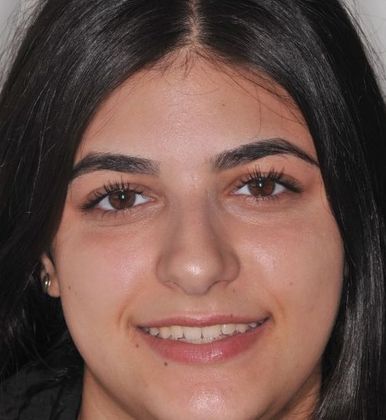 Orthodontics Closing spaces - After