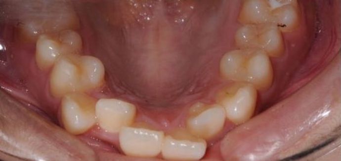 Orthodontics: crowding - Before