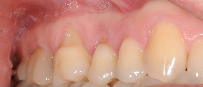 Gum graft Receiding gums - Before