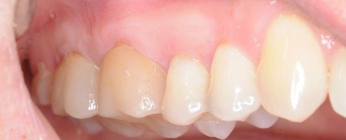 Gum graft Receiding gums - After