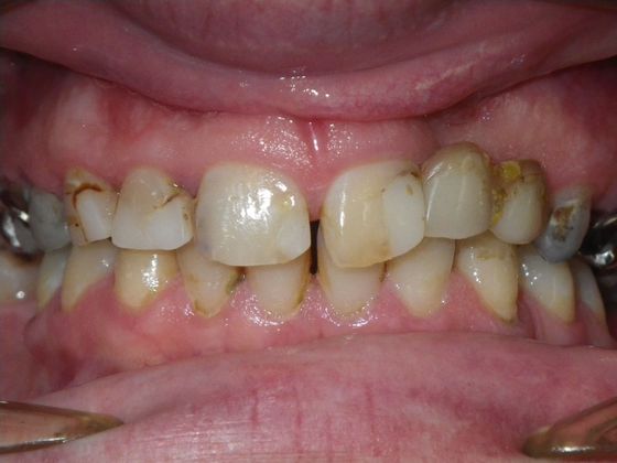 Same Day Service With Ceramic Restorations:  Case 3 - Before