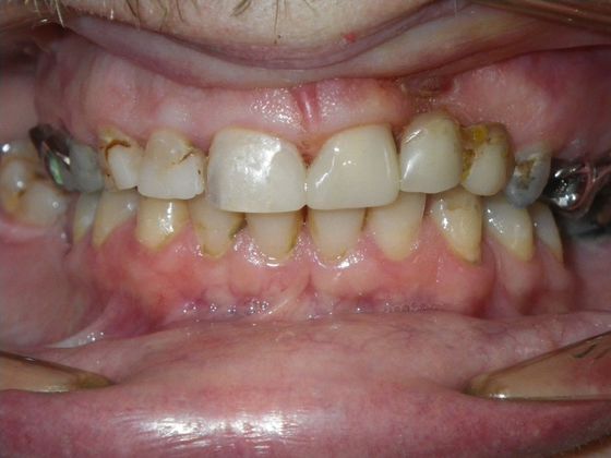 Same Day Service With Ceramic Restorations:  Case 3 - After