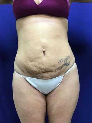 Body Buttock Enhancement: Case 7 (31212) - After. Notice looser tummy skin after fat removal, as expected.