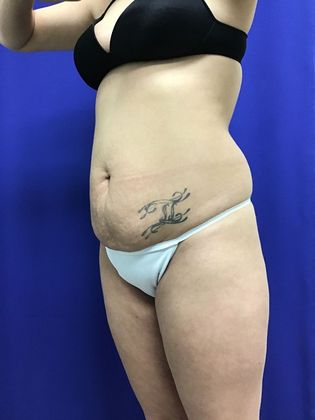 Body Buttock Enhancement: Case 7 (31212) - Before shows how the waist excess and flatter butt detract from her figure.