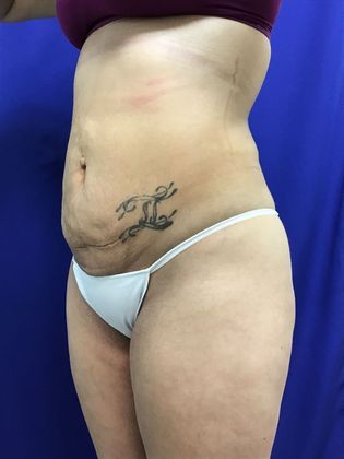 Body Buttock Enhancement: Case 7 (31212) - After.  Much better shape.