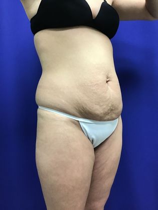Body Buttock Enhancement: Case 7 (31212) - Before