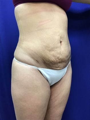 Body Buttock Enhancement: Case 7 (31212) - After.  More flattering figure.