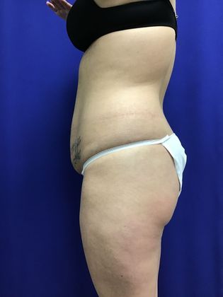 Body Buttock Enhancement: Case 7 (31212) - Before