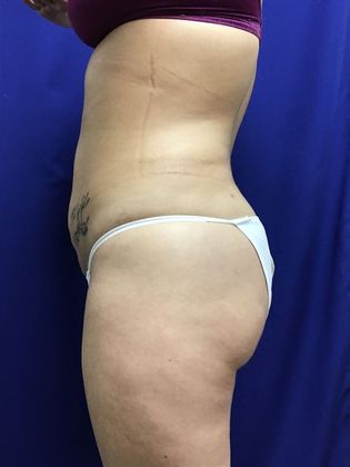 Body Buttock Enhancement: Case 7 (31212) - After, rounder butt
