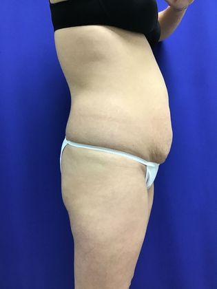 Body Buttock Enhancement Case 7 (31212) - Before