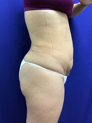 Body Buttock Enhancement Case 7 (31212) - After
