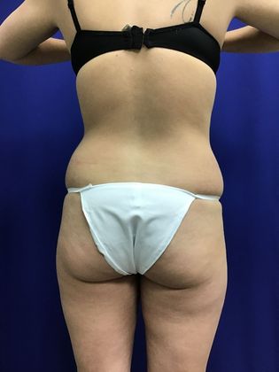 Body Buttock Enhancement: Case 7 (31212) - Before.  Muffin-top