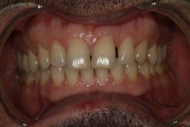 Porcelain Veneers: Upper and lower veneers for smile makeover - Before