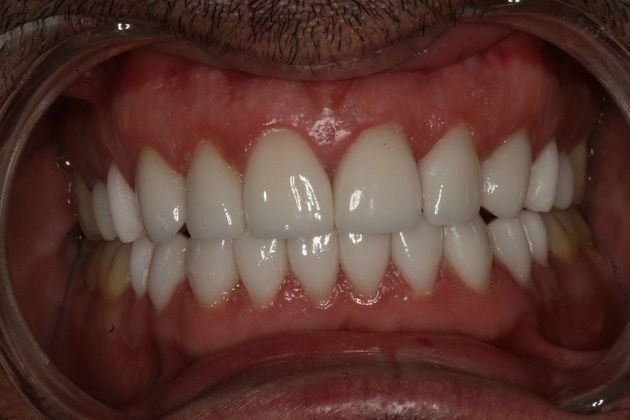 Porcelain Veneers: Upper and lower veneers for smile makeover - After