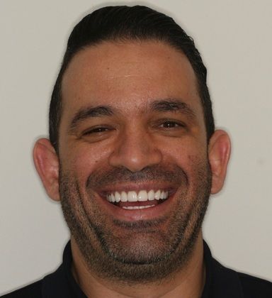 Porcelain Veneers Upper and lower veneers for smile makeover - After