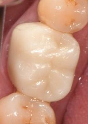 Crowns: Case 23 - Victoria, TX - Before