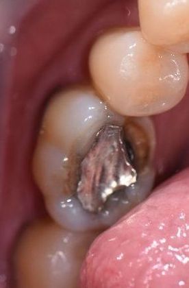 Crowns: Case 23 - Victoria, TX - Before