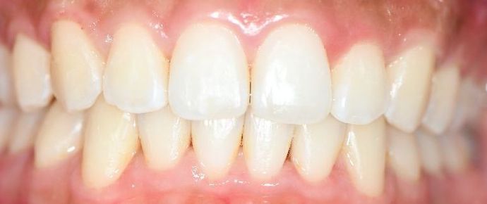 Invisalign Case 4 - Halletsville, TX - After