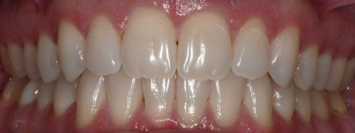 Invisalign: Case 7 - Corpus Christi, TX